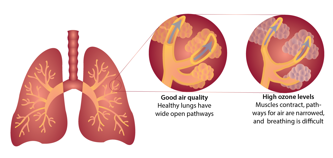 Diagram of the trachea, lungs, and bronchial tubes showing how ozone affects breathing. When air quality is good, normal lungs have wide open pathways for air and breathing is easy. When ozone levels are high, muscles in the bronchial tubes contract, the pathways for air are narrowed, and breathing is difficult.